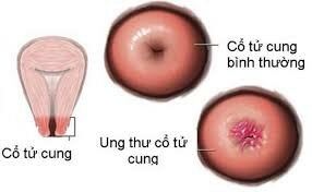 Sau ung thư vú, ung thư cổ tử cung là nguyên nhân thứ 2 gây ra tử vong ở phụ nữ